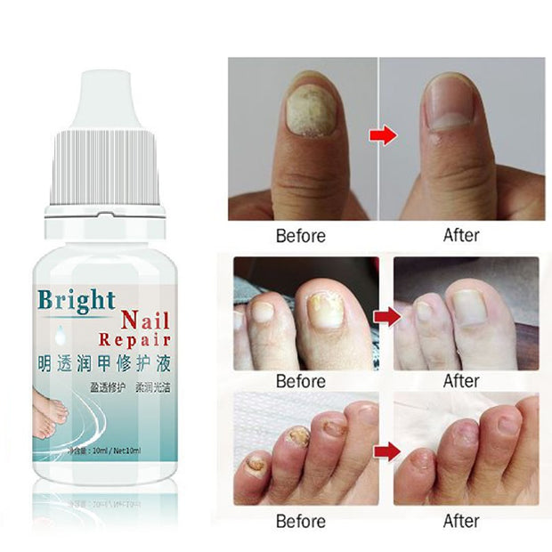 Fungal Nail Treatment for Toe Nail Fungus Removal